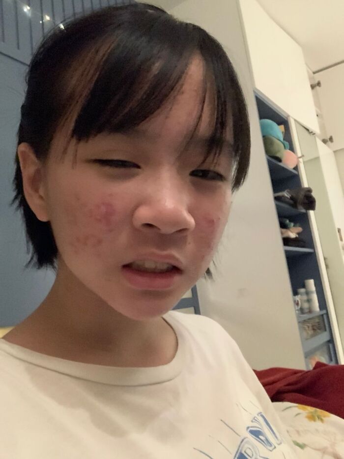 hình ảnh gái xấu có mụn